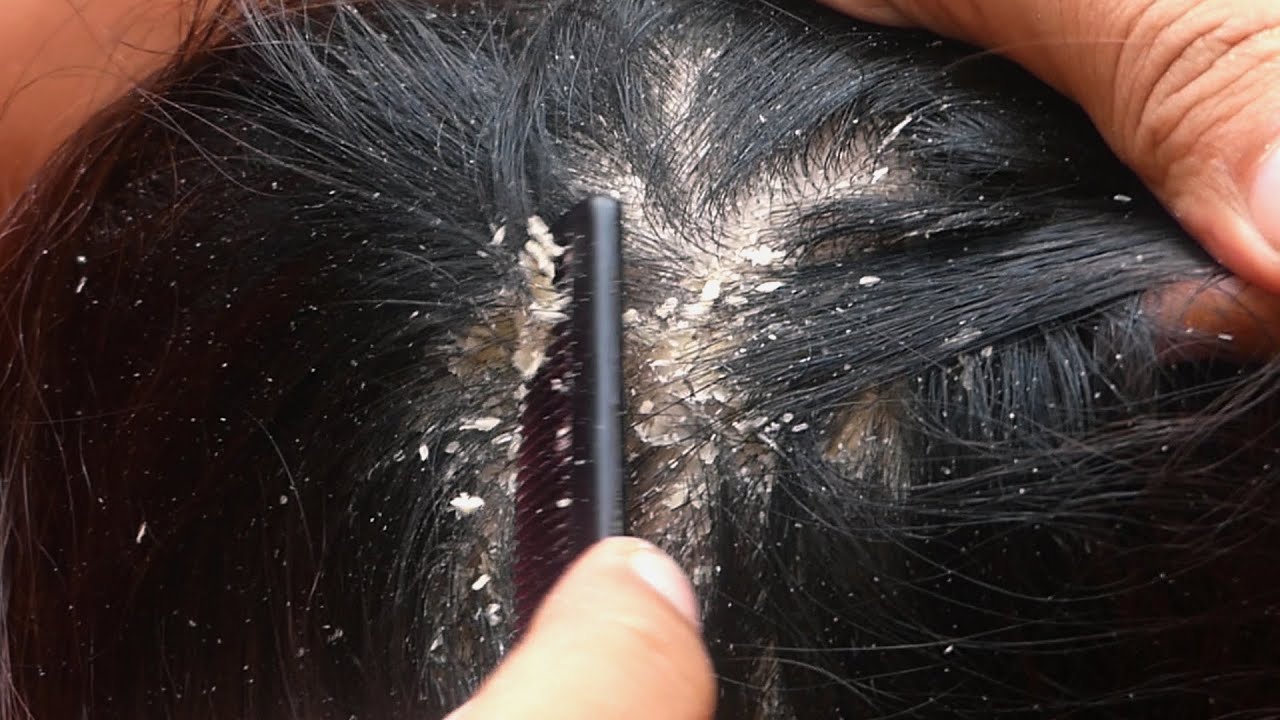 dandruff scratching big flakes by toktok tv - YouTube