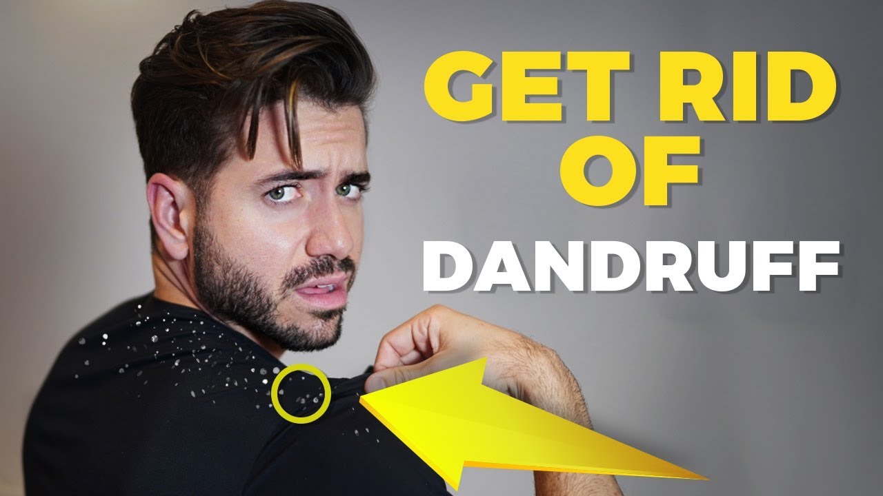 HOW TO GET RID OF DANDRUFF | Men's Hair | Alex Costa - YouTube
