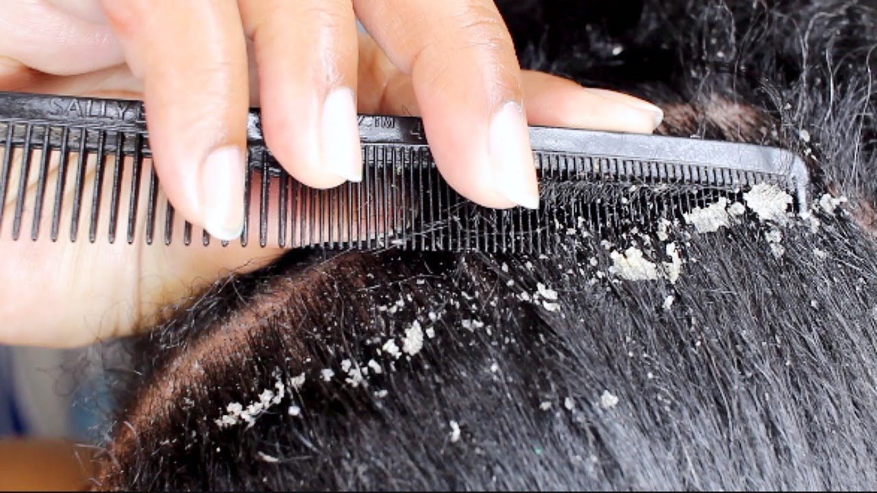MY BEST FLAKES EVER!!!!! | Scalp scratching and picking | Satisfying  Dandruff Removal ASMR - YouTube