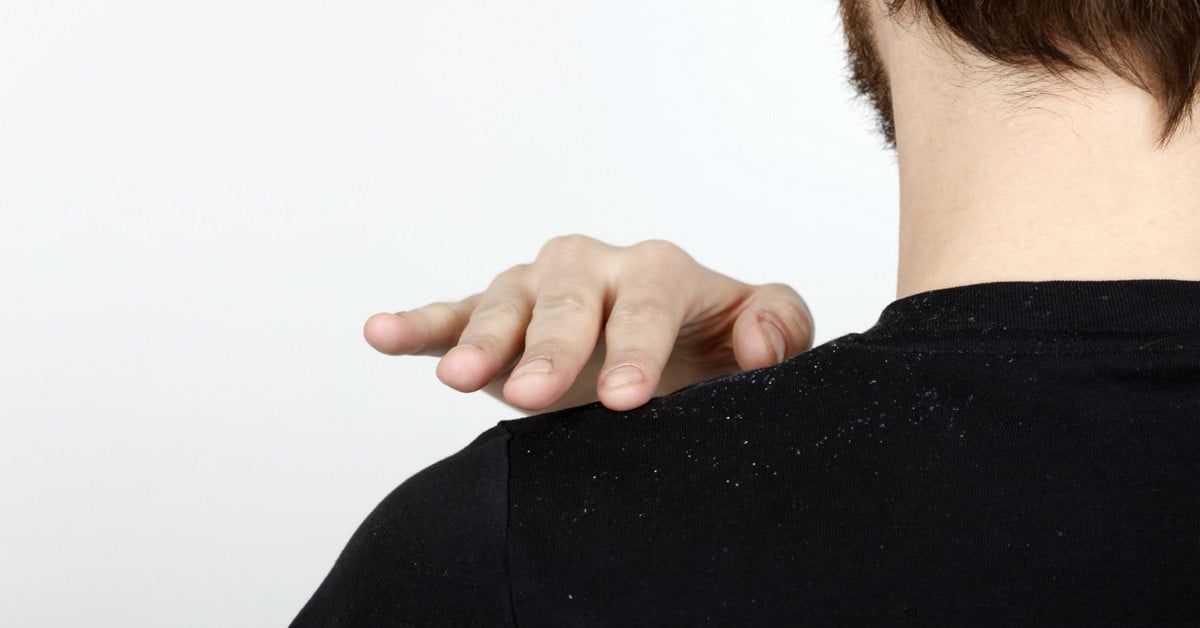 Best Dandruff Shampoo for Men to Eliminate White Flakes | The Manual | Mens  shampoo, Dandruff, Shampoo